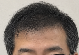 Cさん 生え際・前頭部 治療後