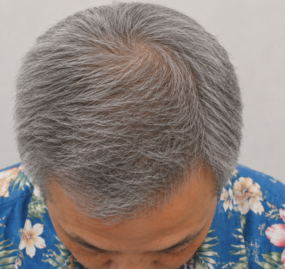 Eさん 頭頂部 治療後
