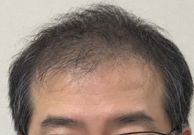 Cさん 生え際・前頭部 治療前