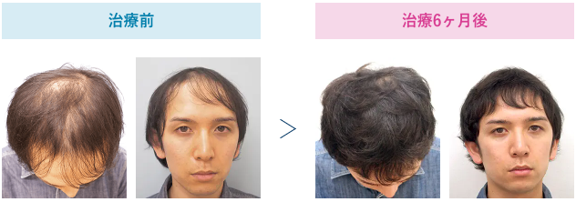 33歳 治療6ヶ月後のビフォーアフター
