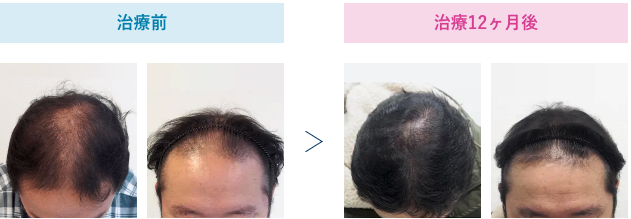 46歳 治療12ヶ月後のビフォーアフター