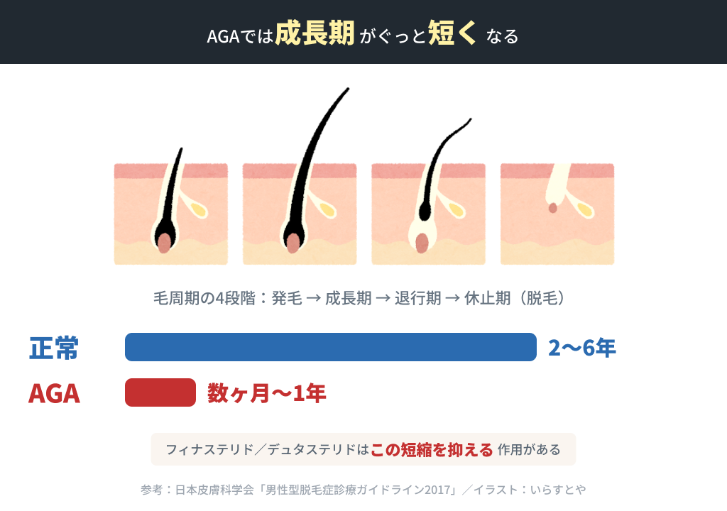 AGAでは成長期がぐっと短くなる ヘアサイクル比較