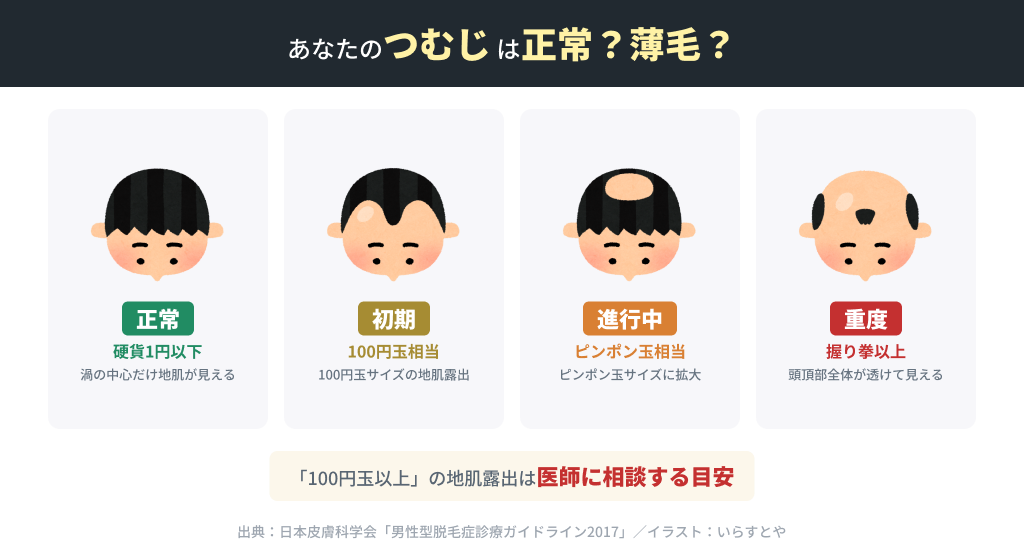 つむじ4段階 正常から重度までの進行度